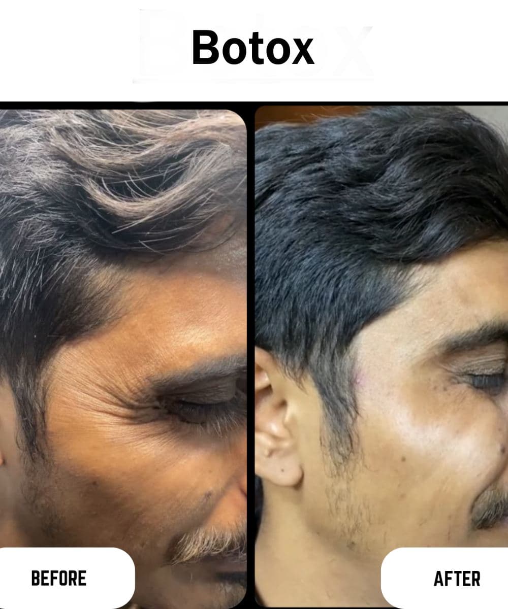 Botox before and after at Prime Skin Clinic