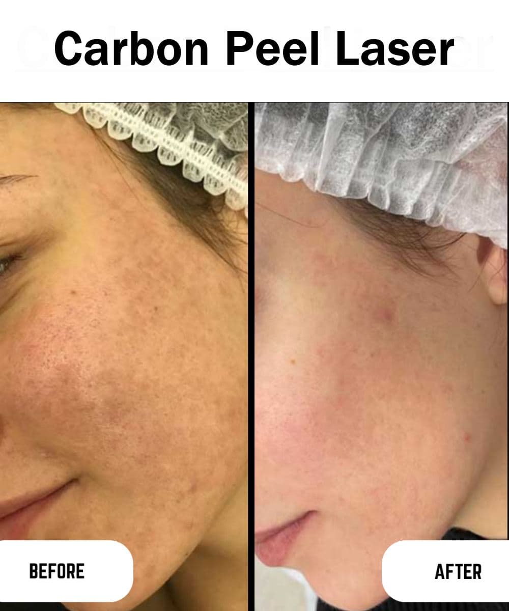 Carbon Peel Laser before and after at Prime Skin Clinic