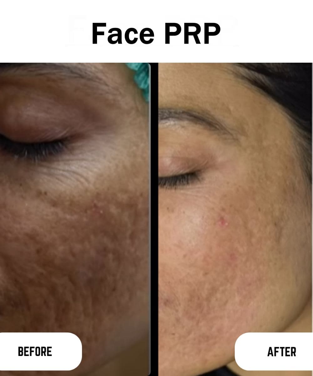 Face PRP before and after at Prime Skin Clinic