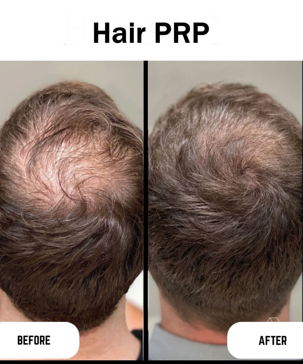 Hair PRP before and after at Prime Skin Clinic