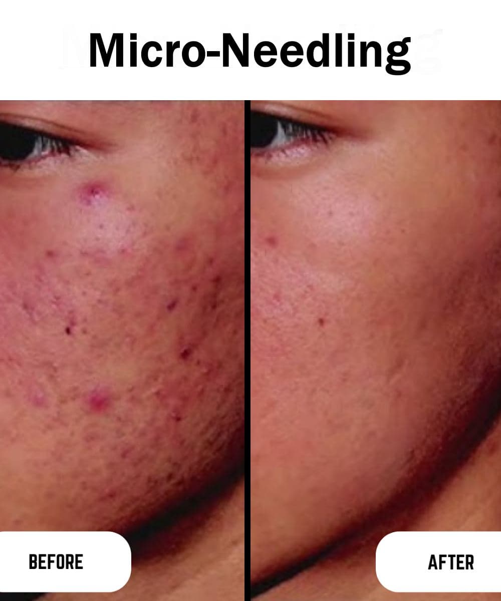 Micro-Needling before and after at Prime Skin Clinic